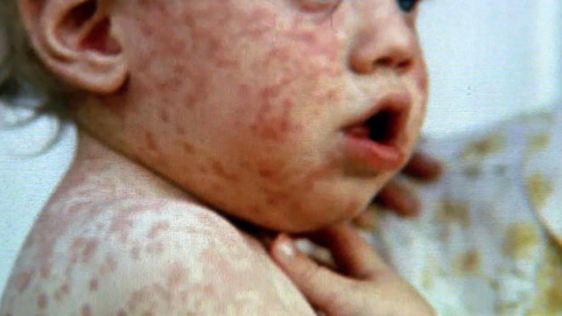 Measles