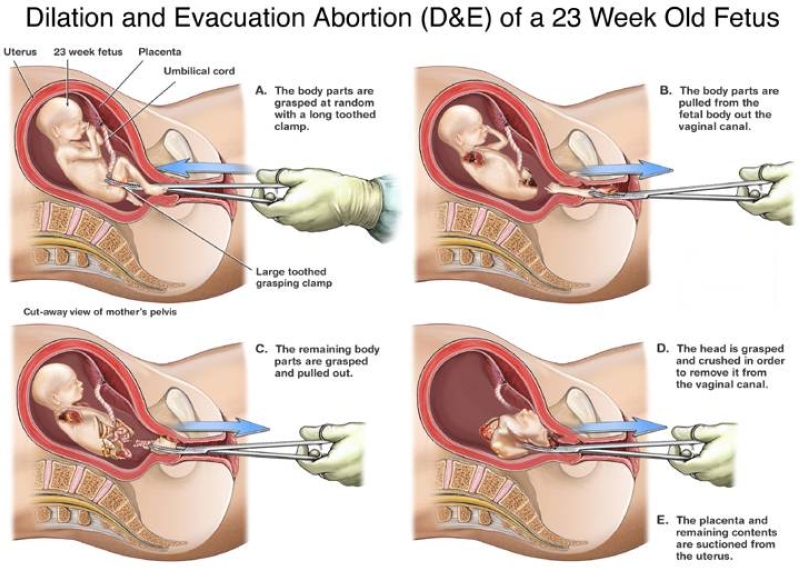 Abortion
