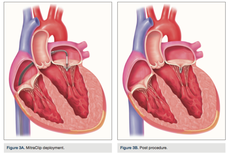 mitral valve replacement 