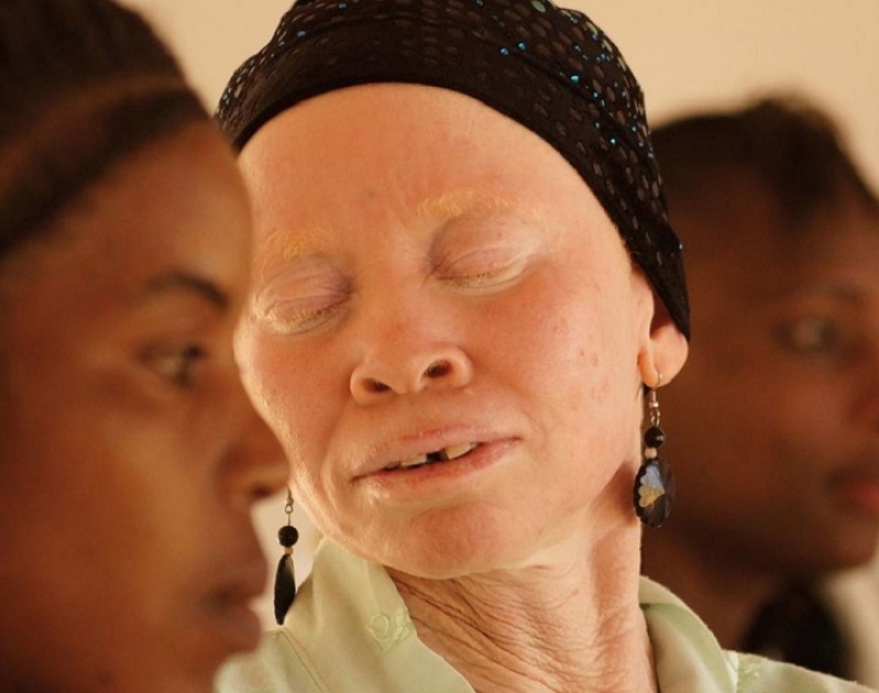 Tanzania Albinos