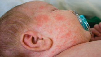 Disneyland Measles Outbreak in California Highlights Absurdity of Anti-Vaccine Movement