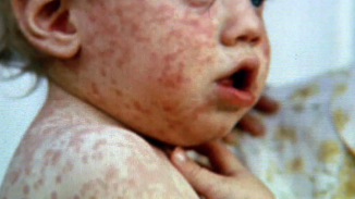 California Measles Virus Outbreak: Symptoms and Signs, Treatments and Vaccines, and Prevention