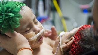 Houston Doctors Successfully Separate 10-Month-Old Conjoined Twins after Long Grueling Procedure